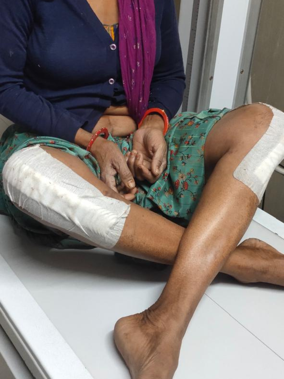 After Knee replacement