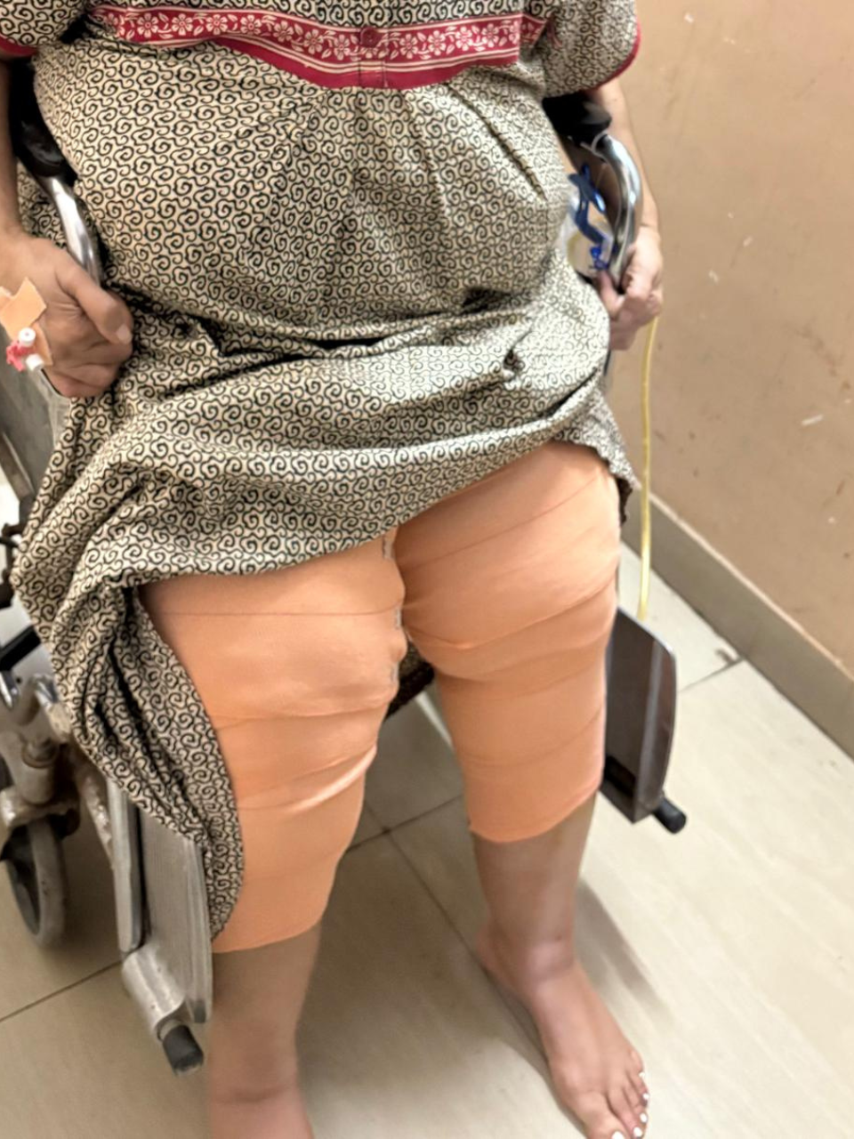 Post Knee replacement