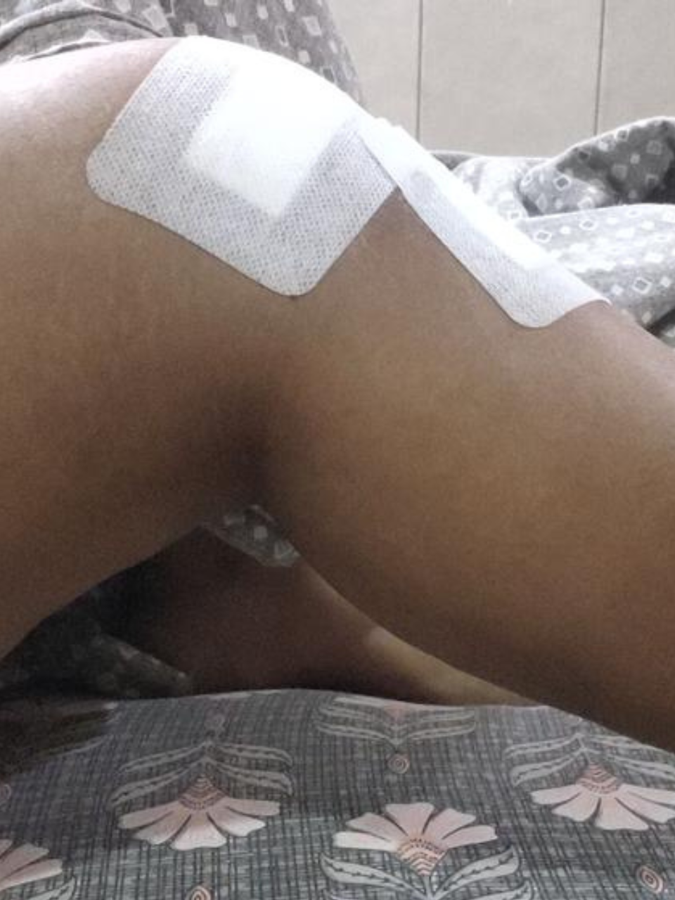 Post ACL rehabilitation